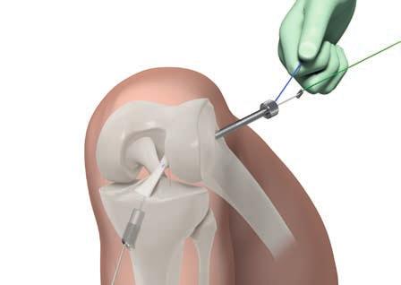 Recolocación del muñón tibial Tensar de dos en dos los hilos de sujeción