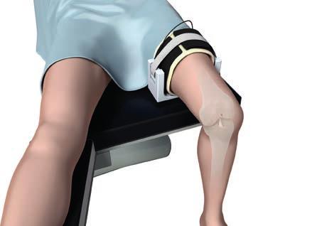Colocación del paciente y abordaje de artroscopia Posición en decúbito supino con soporte de pierna: Técnica del acceso anteriomedial, es decir, capacidad de flexión de 130.