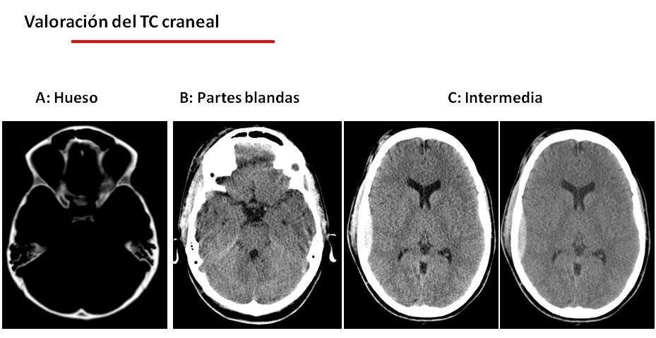 2 Cómo debe el clínico analizar la TC cerebral en un paciente que ha presentad un TCE? estas fracturas (lineales, conminutas, deprimidas.) y dónde están localizadas.