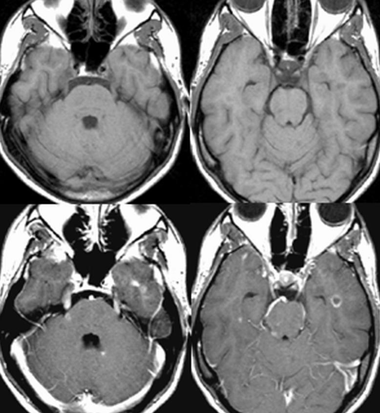 Afección del tronco cerebral Aproximadamente el 3% de los pacientes con EM muestran realce tras contraste tanto en el origen en protuberancia como en la porción intracisternal de los nervios
