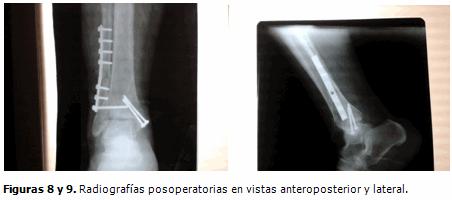 A los cuatro meses de la operación la paciente había recuperado la movilidad de su tobillo. (Figuras 10 y 11).