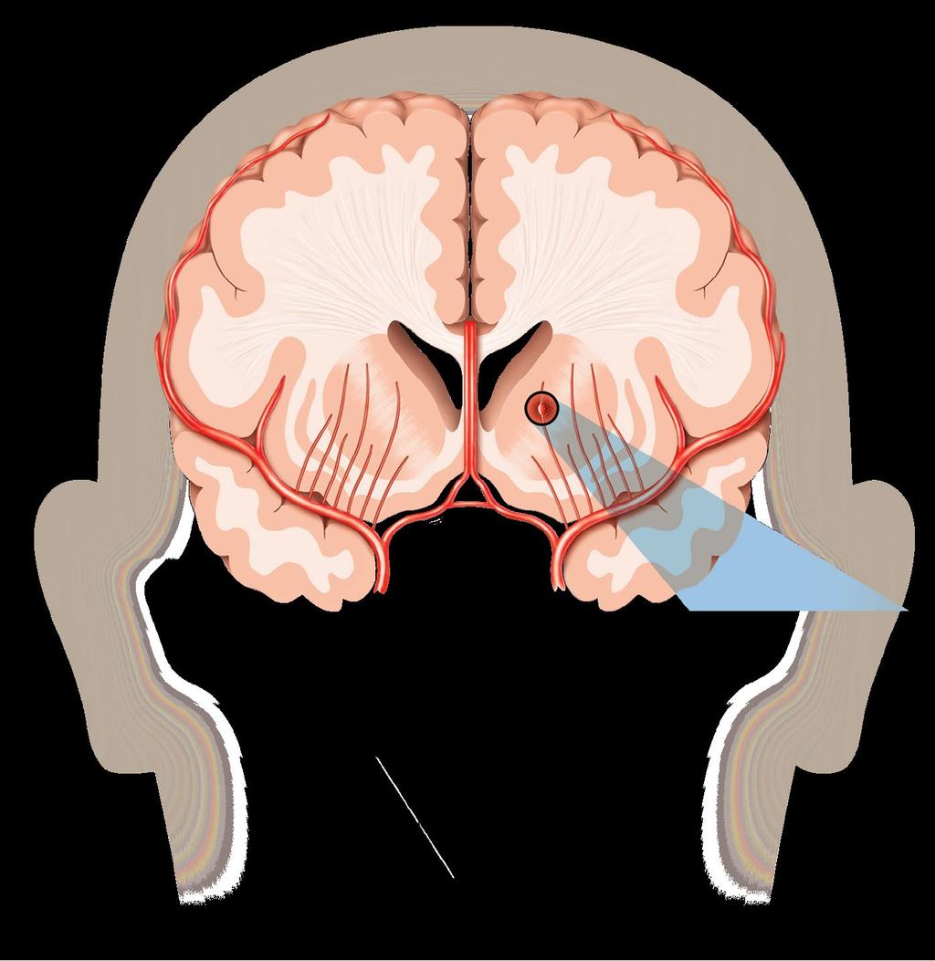 Hemorragia intracerebral Hemorragia cerebral Arteria cerebral media