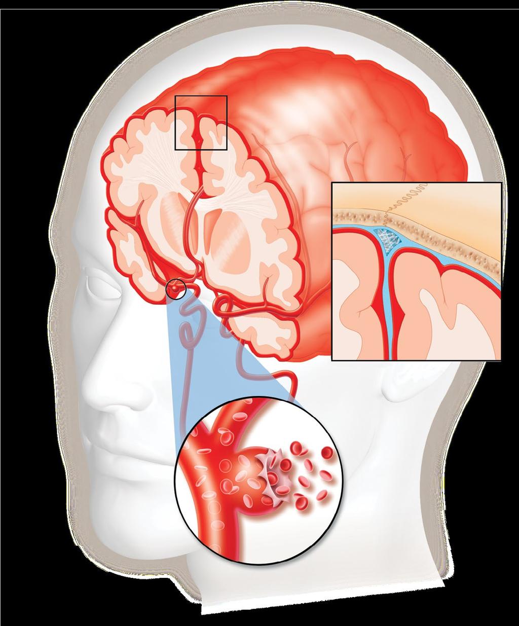 Hemorragia subaracnoidea Espacio subaracnoideo Arteria cerebral media Aneurisma sacular Espacio subaracnoideo (en azul) entre el cráneo y el cerebro (vista ampliada) Otro tipo de ataque