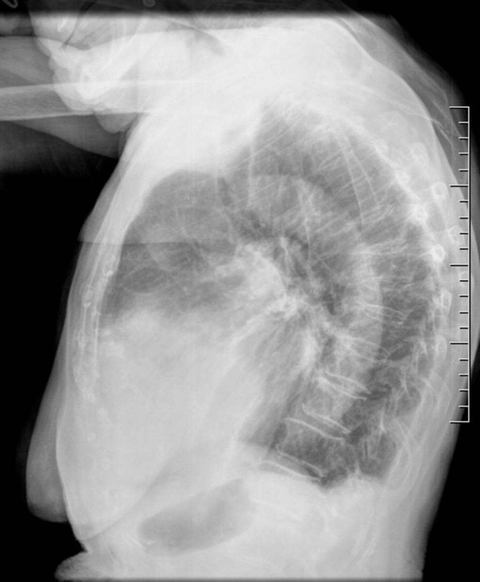 Fig. 2: Radiografía simple (LAT).