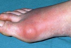coyunturas, y frecuentemente se acumulan en el dedo gordo del pie Depósitos de ácido úrico
