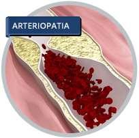 ARTERIOPATIA PERIFÉRICA Incluyen todas las patologías relacionadas con la enfermedad ateroesclerótica que