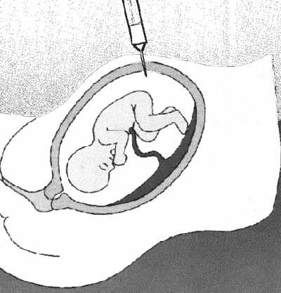 Criterio intervención quirúrgica Amniocentesis y Aspiración contenido quístico u Disconfort materno u Amenaza parto prematuro u Prevención de