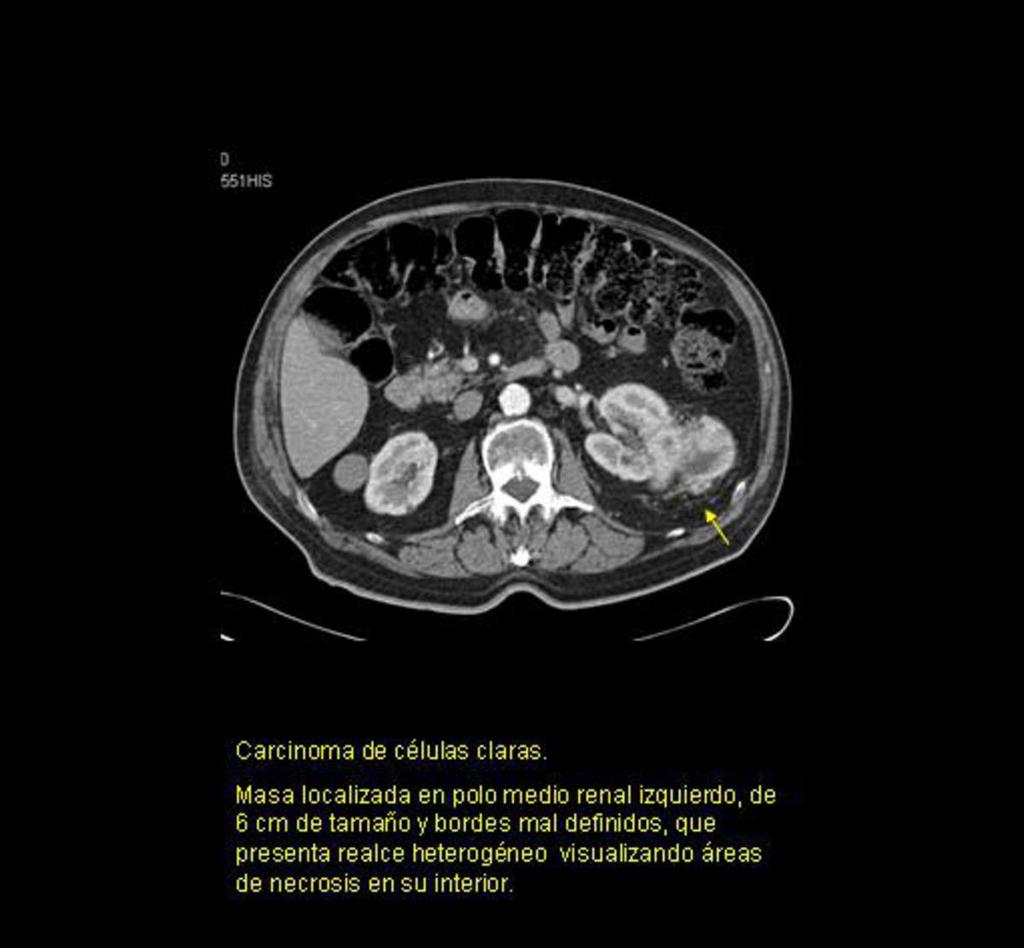Fig. 19: Corte axial de TC abdominal con