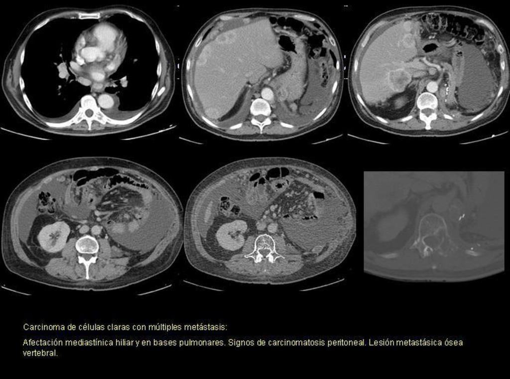 Fig. 39: Cortes axiales de TC toraco-abdominal con contraste en fase arterial (imágenes 1, 2, 3) y en fase