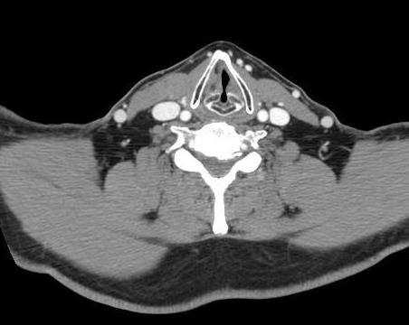 M. esternocleidomastoideo C. tiroides M. platisma Glotis V.