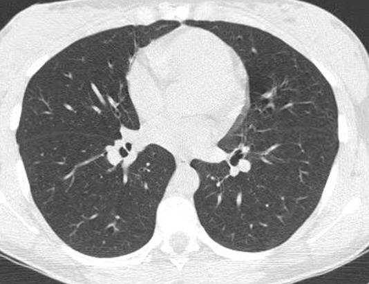 Ventrículo derecho Atrio Derecho Vena pulmonar inferior Vena ácigos Esófago Aorta