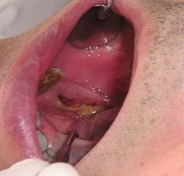 Actas Odontológicas La terapia con bifosfonatos como causa de osteonecrosis de los maxilares. del labio inferior.