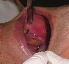 Actas Odontológicas La terapia con bifosfonatos como causa de osteonecrosis de los maxilares. Figura 6. Cirugía con eliminación de todo el hueso patológico. Figura 7.