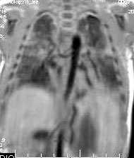 CASO II A Fig. 1: Paciente de 9 días de vida, con diagnóstico ecocardiográfico de DVPAT supracardiaco y atresia pulmonar.