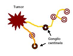Definición de GC Es el ganglio o ganglios linfáticos regionales que reciben el drenaje linfático directamente desde