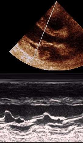 Pared posterior - iámetro sistólico VI