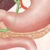 Cuando la vesícula biliar está sana Arteria cística Hígado Vesícula biliar Conducto cístico Conducto biliar común Duodeno El