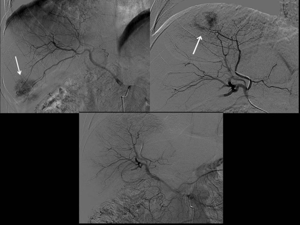Fig. 2: DSA del mismo paciente de la figura 1 en el que se identifican dos lesiones nodulares hipervasculares en la arteriografía (arriba).