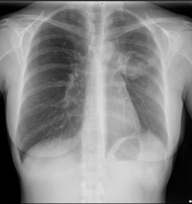 Exploraciones complementarias Radiografía de tórax: masa pulmonar parahiliar izquierda. Resonancia magnética: Masa pulmonar en lóbulo superior izquierdo (57 x 44 mm).
