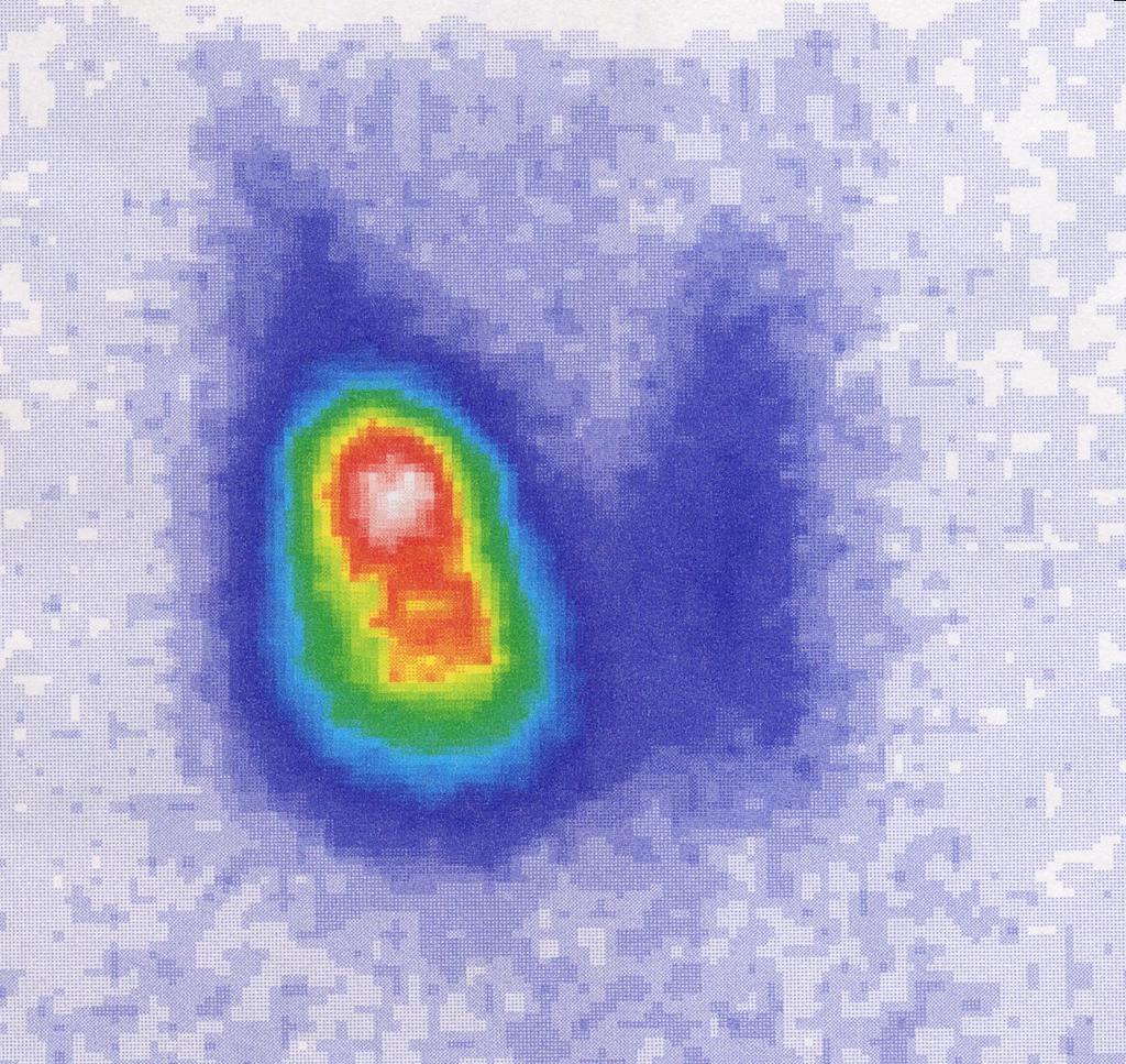 Nódulo autónomo Nódulos usualmente grandes, mayores de 3-4 cm de diámetro Usualmente se logran palpar US muestra nódulo único o BMN Ausencia de signos extra9roideos de enfermedad de Graves Producido
