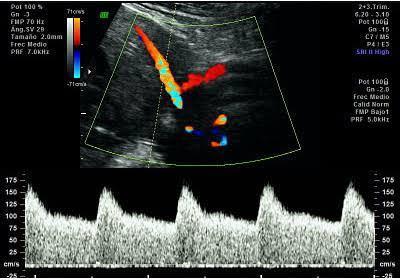 Realizar un USG Doppler uterino y un seguimiento prenatal más estricto en las pacientes con riesgo epidemiológico elevado: Antecedente de preeclampsia
