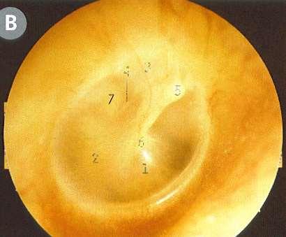 Oído Medio: Cavidad timpánica Porción flácida de la membrana