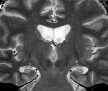 Cuerpo del Ventrículo Lateral Núcleo caudado Hipocampo Giro dentado Tercer Ventrículo Surco del hipocampo Subículo Núcleo