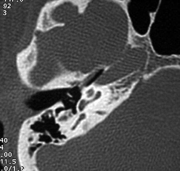 Arteria carótida interna Seno esfenoidal Trompa auditiva Conducto auditivo externo Martillo Promontorio