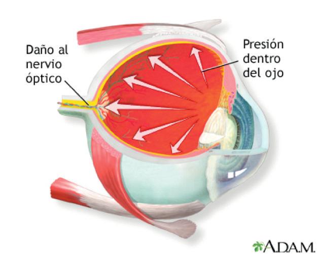 QUÉ ES EL? El glaucoma es una enfermedad ocular que daña el nervio óptico produciendo una perdida irreversible de visión. Por qué se produce?