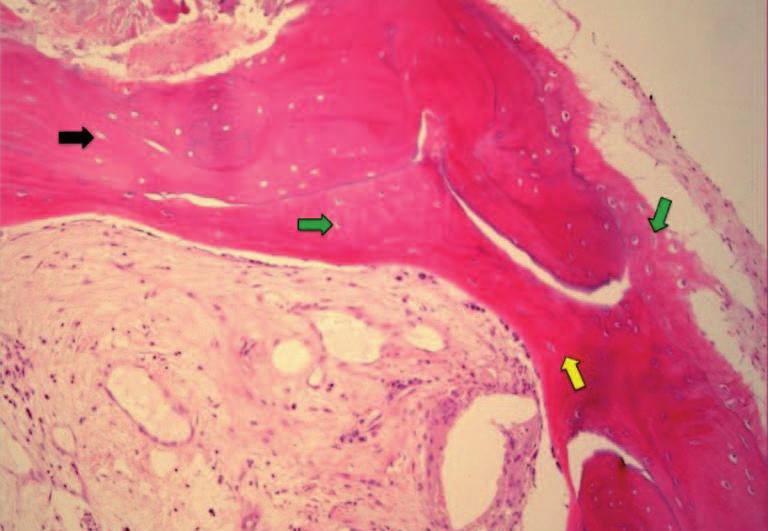 HISTOLOGÍAS Y DENSIDAD* Se evidencia un robusto crecimiento interno de hueso nuevo en el SmartBone injertado (flecha negra) por la presencia de osteocitos dentro de la estructura ósea (flecha