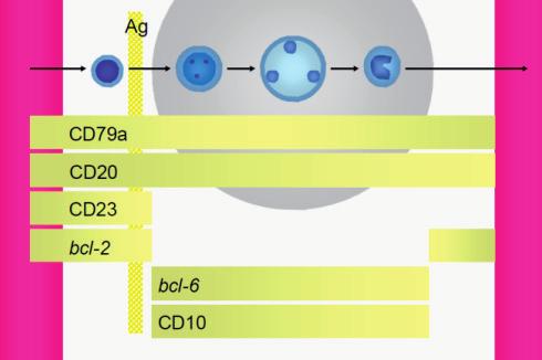 Burkitt En el caso del linfoma de Burkitt encontramos expresión fuerte/moderada de IgM de superficie con restricción de cadenas ligeras y positividad para marcadores pan-b (CD19, CD20, CD22), así