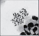 Resultados de la citogenética de sangre periférica: Se detectó una translocación t(8;22)(q24;q11) y reordenamiento del gen c-myc con la cadena ligera lambda de las inmunoglobulinas.