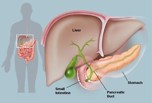Páncreas Pancreatitis: Dolor que irradia y