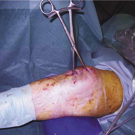 Fijación percutánea asistida por artroscopia [ ] Figura 4. Fijación percutánea con clamp.