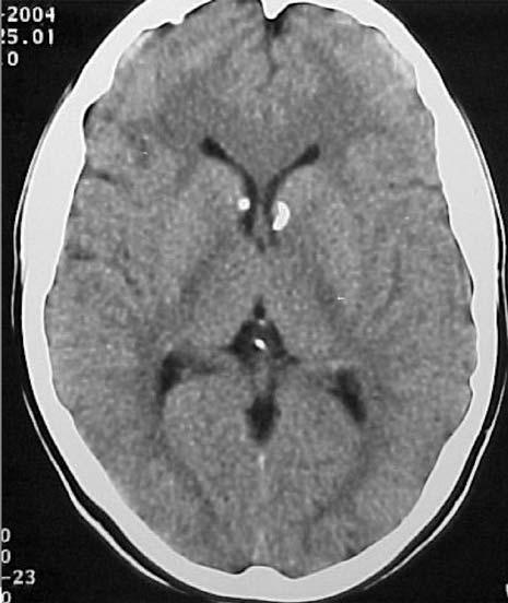 Figura 3. Tomografía de cerebro. gioleiomiomas de pulmón, patología que inicialmente había sido obviada durante el interrogatorio.