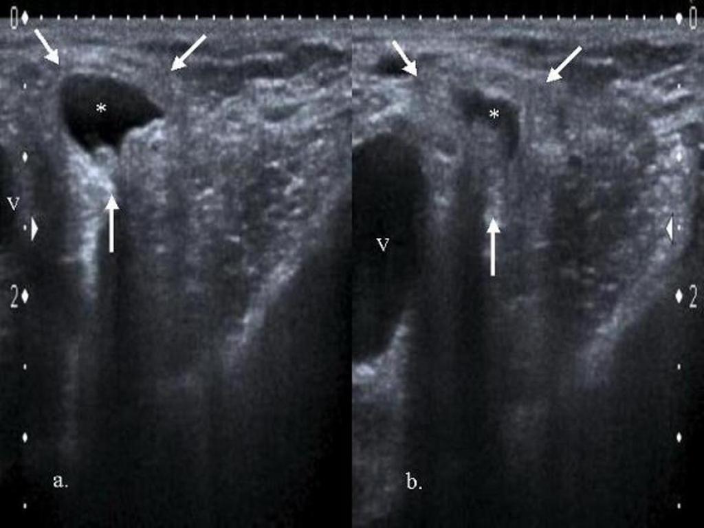 Fig. 7: Hernia femoral derecha con protrusión de grasa (flechas) y líquido (asterisco), en íntima relación con la vena femoral (V),