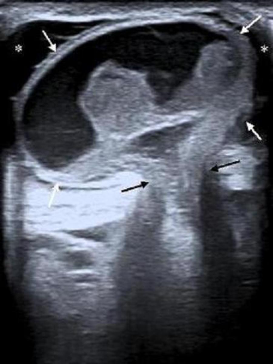 Fig. 8: Ecografía inguinal en la que se observa la protrusión de un asa de intestino deldago dilatada (flechas blancas) y de