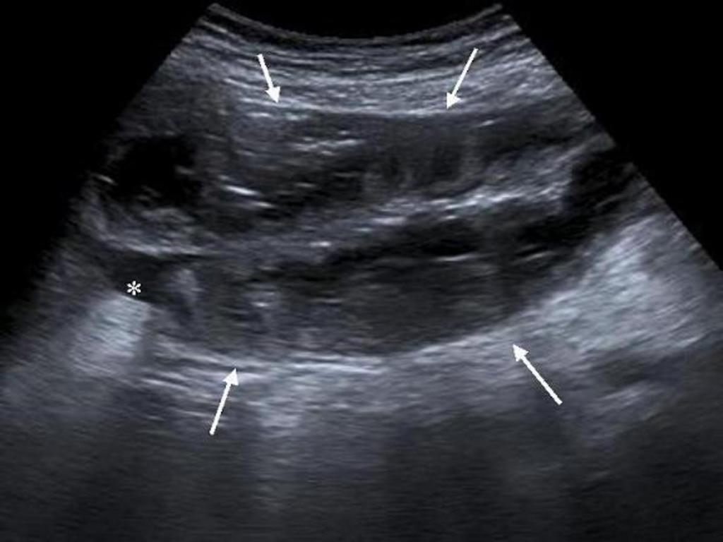 Fig. 9: Ecografía abdominal del mismo paciente en la que se observa dilatación proximal de asas de intestino delgado (flechas) y