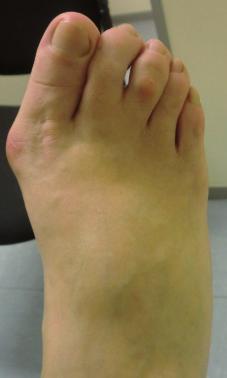 Al realizar la artrodesis también se debe valorar si el paciente presenta un pie plano o un pie cavo y, por tanto, la mayor o menor verticalización del primer metatarsiano.