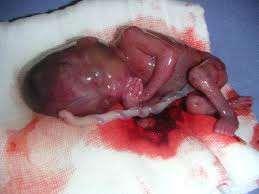 Un aborto es la terminación de un embarazo.
