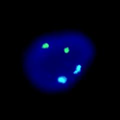 Detección de aneuploidias por FISH (fluorescent in situ hybridiza@on) 13 X X 13 21 21 21 18 18 Prueba de aneuploidía: se han combinado núcleos en interfase procedentes de células de fluido amniótico