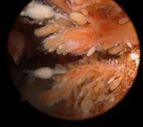 TRATAMIENTO Se realizó un procedimiento artroscópico en el que se evidenció un pinzamiento entre el tejido sinovial hiperplásico y los componentes protésicos.