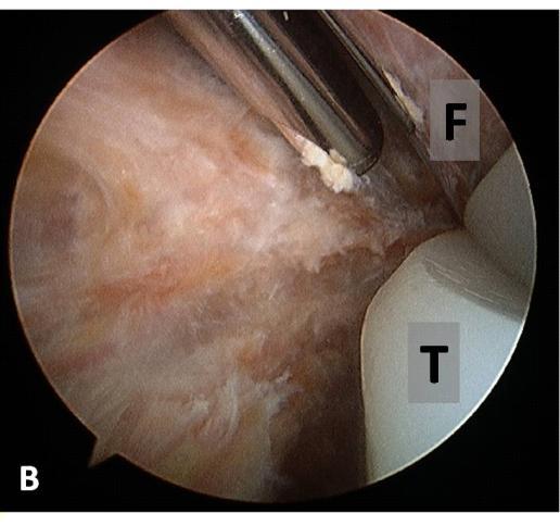 Si la sinovectomía artroscópica no es exitosa, el cirujano debe realizar una sinovectomía abierta en la que el retiro del inserto de polietileno permitirá acceder a la región posterior de la rodilla