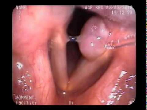 tiroaritenoideo Mucosa Falsas