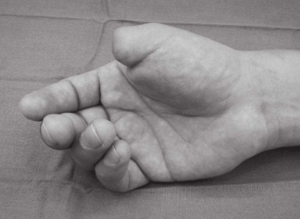 6a 6c 6b Figura 6 a-c. Transferencia parcial del primer ortejo del pie. a) Paciente de 38 años, con amputación del pulgar derecho. b) Cirugía y disección de transferencia parcial de primer ortejo.