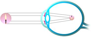DEFECTOS DE LA VISIÓN Miopía. El ojo miope tiene un sistema óptico con un exceso de convergencia. La persona miope no ve bien de lejos, pero puede enfocar bien los objetos cercanos.