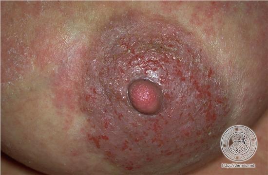 Actínicas Eczemas