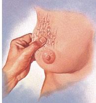 quiste mamario es una lesión que se manifiesta como un bulto en forma de saco rodeado por una cápsula y que contiene líquido - Constituyen las tumoraciones benignas más frecuentes de la mama -