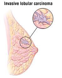 Representa el 10 % de todos los Ca de mama Su clinica es variable: Multifocal multicentrico y bilateral Difícil de diagnosticar por su carácter insidioso y características sutiles en la mamografía