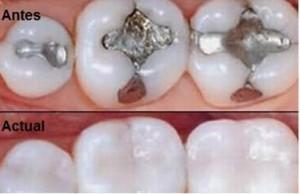 Diagnóstico de los residuos de mercurio por amalgamas dentales en el contexto del Convenio de